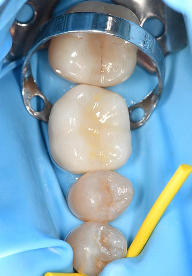 Byron Park 24 Implant 3Shape-2