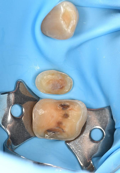 Dental Implant Treatment from Start to Finish using 3Shape TRIOS