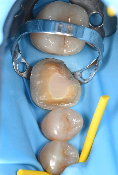 Byron Park 24 Implant 3Shape