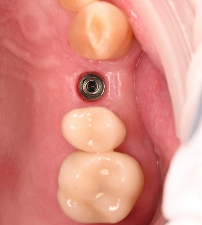 dental implant restoration 2