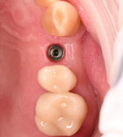 dental implant restoration 2