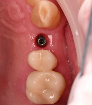 3 months after implant placement. An excellent volume of buccal contour