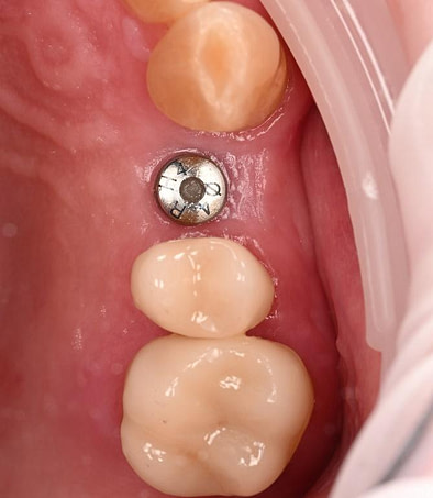 3 months after implant placement