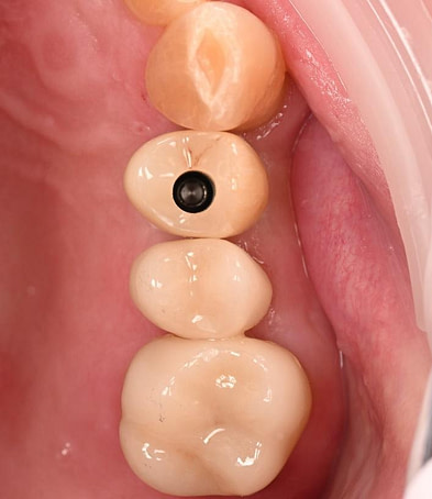 dental implant restoration 3