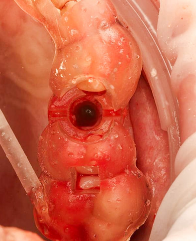 The Osstem OneGuide kit is used with a fully guided osteotomy and implant placement