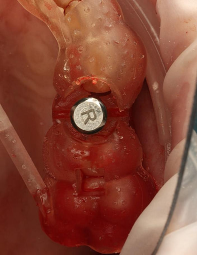 Implant inserted using a motorised driver