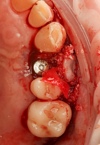 A 50-50 mix of xenograft_allograft particulate bone graft was used to augment the buccal defect