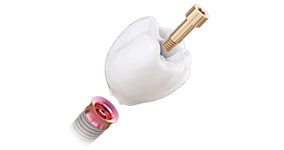 DDD-Podcast-S2E6-tri-dental-matrix-line-implants-idd-institute-of-digital-dentistry