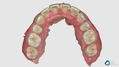 full arch scan runyes 3DS IOS institute of digital dentistry (2)