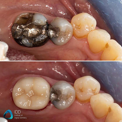 e.max ceramic restorations milled with primemill cerec same day crown (2)