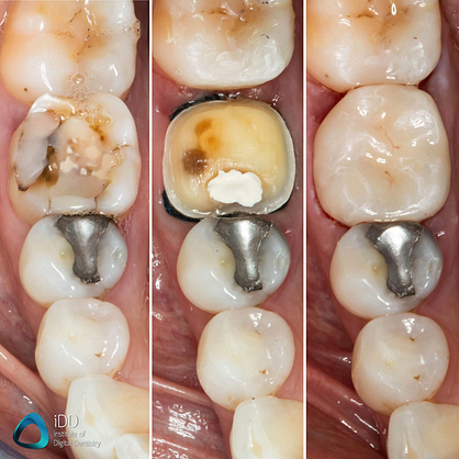 e.max ceramic restorations milled with primemill cerec same day crown (4)