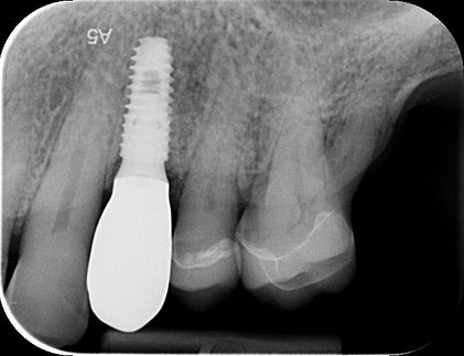PA radiograph