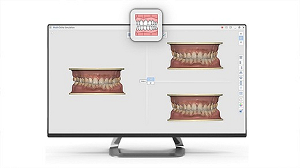 Medit orthodontic simulation