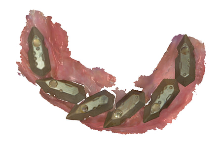 Fig.7+Tissue+and+Multi+Unit+Abutments+-+Scan+Gauge+Scan+1