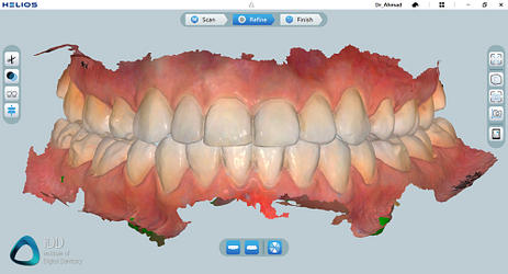 helios 600 intraoral scanner review software overview institute of digital dentistry (1)