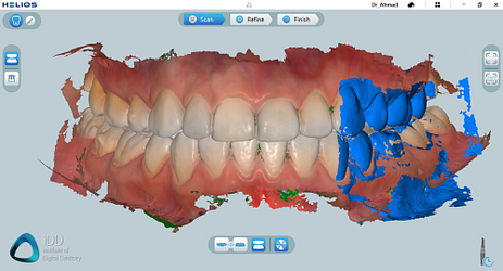 helios 600 intraoral scanner review software overview institute of digital dentistry (2)
