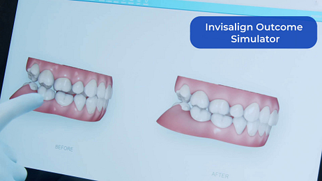 invisalign-outcome-simulator-itero-element-5d-plus-unboxing-idd