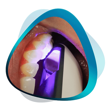 Intraoral Scanning