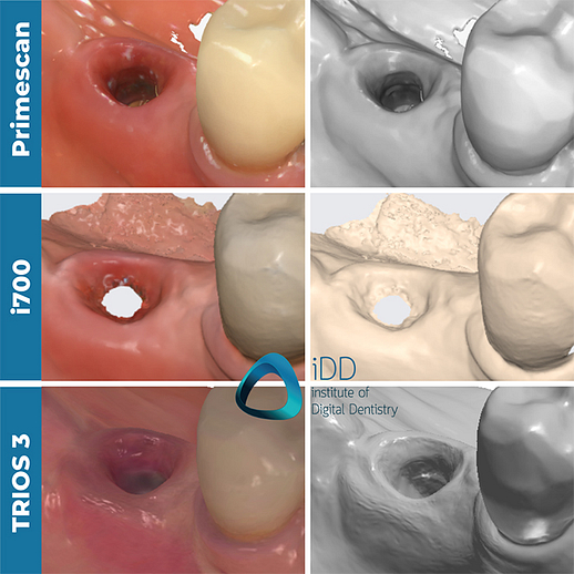 implant-scan-with-trios-medit-cerec-institute-of-digital-dentsitry (1)