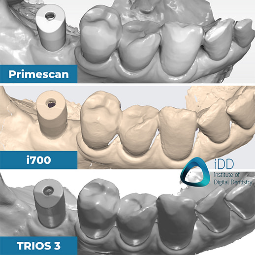 implant-scan-with-trios-medit-cerec-institute-of-digital-dentsitry (2)
