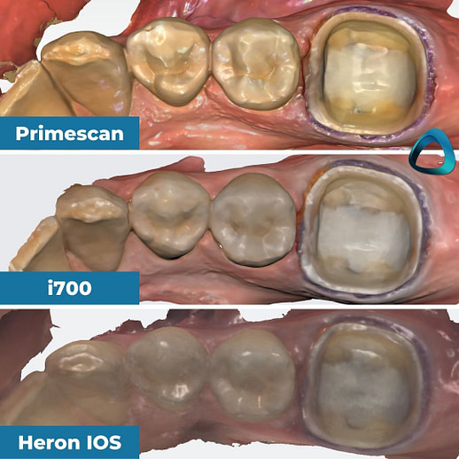 02-individual-color-scans-in-their-native-software-idd-compares-intraoral-scanners-expensive-vs-cheap-compared-cerec-primescan-vs-medit-i700-vs-heron-ios