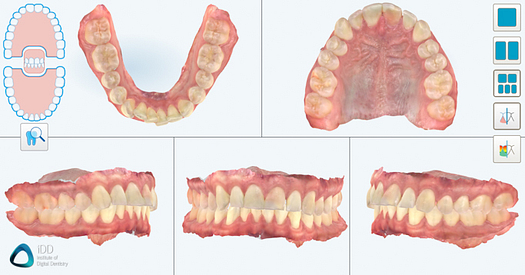 itero element 5D plus review full arch scanning institute of digital dentistry idd