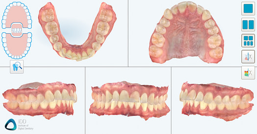 itero element 5D plus review full arch scanning institute of digital dentistry idd