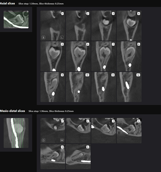 Third Molar Slices 2