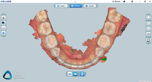 helios 600 intraoral scanner review software overview institute of digital dentistry (5)