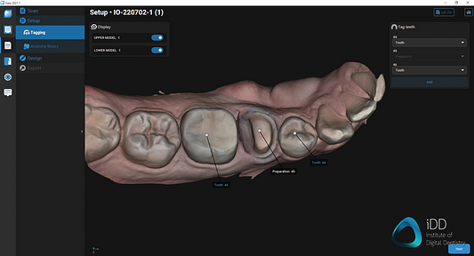 straumann virtuo vivo intraoral scanner review institute of digital dentistry (45)