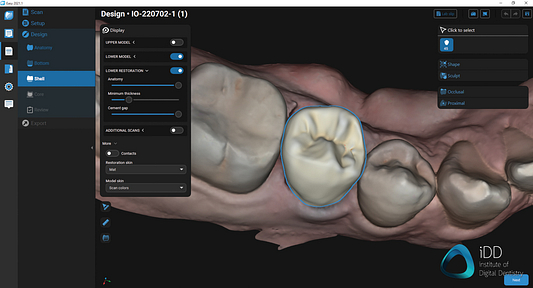 straumann virtuo vivo intraoral scanner review institute of digital dentistry (50)