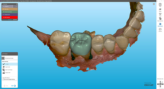 itero_design_suite_Lumina_iDD_digital_dentistry