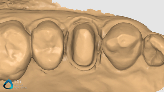 helios 600 medit i700 scans compare idd (2)
