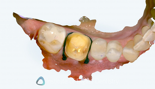 itero_lumina_iDD_review_institute_of_digital_dentistry_align_technology44