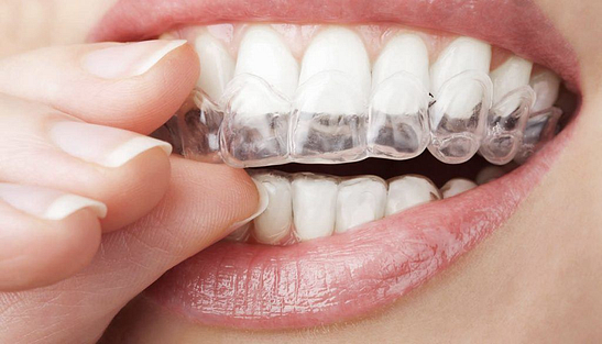 Invisalign-1024x586