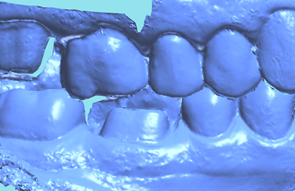 top five mistakes when scanning institute of digital dentistry iDD (2)