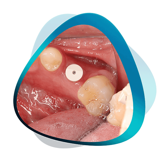 Digital implantology bundle