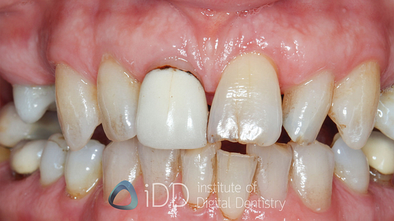 Fig-04-Olivia-before-how-to-transition-into-digital-dentistry-workflows-watermarked
