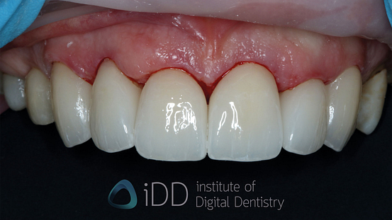 Fig-05-Olivia-after-how-to-transition-into-digital-dentistry-workflows-watermarked