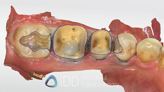 Fig-12-Matt-prep-+-margin-how-to-transition-into-digital-dentistry-workflows-watermarked