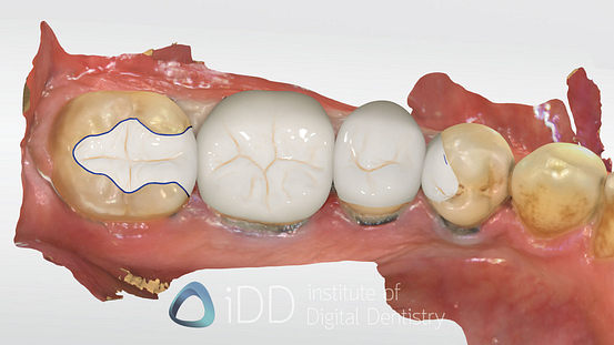 Fig-13-Matt-design-how-to-transition-into-digital-dentistry-workflows-watermarked