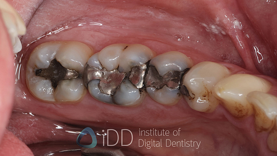Fig-10-Matt-before-how-to-transition-into-digital-dentistry-workflows-watermarked