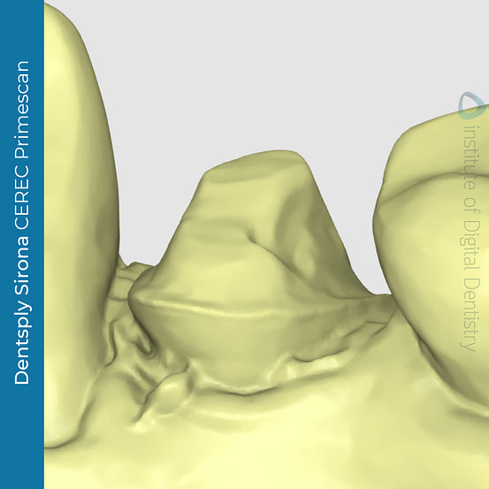 CEREC-primescan-margin-line