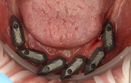 Fig.5+Tissue+and+Multi+Unit+Abutments+-+Scan+Gauges