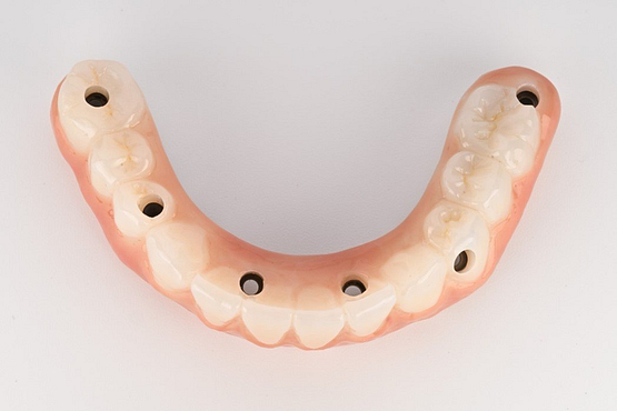 Fig.9+Tissue+and+Multi+Unit+Abutments+-+Final+Prosthesis+Lower+Zirconia