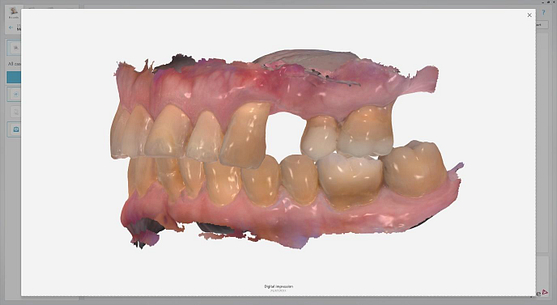 Byron Park 24 Implant 3Shape scan