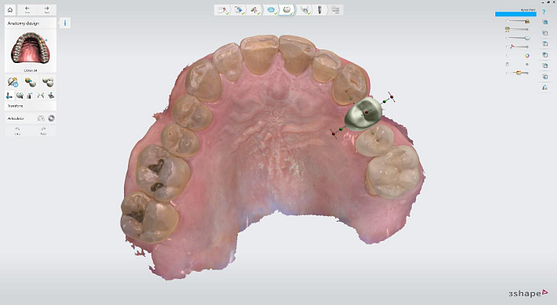 Virtual crown design before implant planning 2