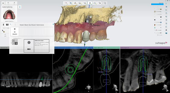 implant libray selection