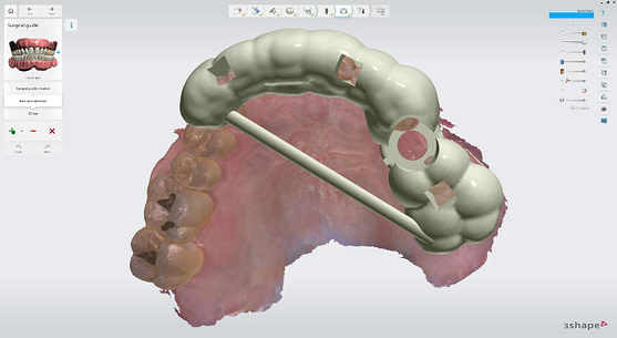 Dental Implant Treatment from Start to Finish using 3Shape TRIOS