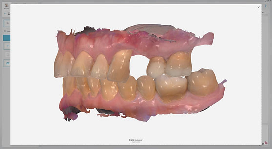 Byron Park 24 Implant 3Shape scan